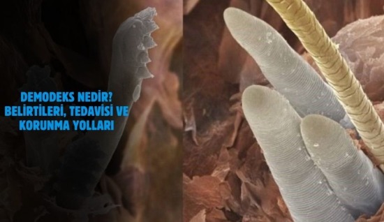 Demodeks Nedir? Belirtileri, Tedavisi ve Korunma Yolları