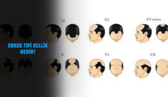 Erkek Tipi Kellik (Androgenetik Alopesi) Nedir?